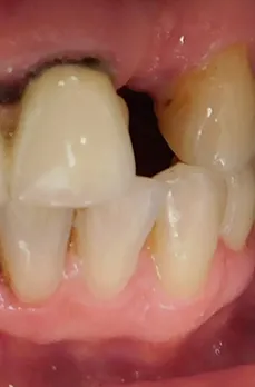 Зубы до имплантации — пациент клиники EK Dental, Екатеринбург