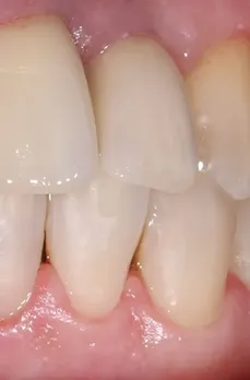 Зубы после имплантации и протезирования в EK Dental, Екатеринбург
