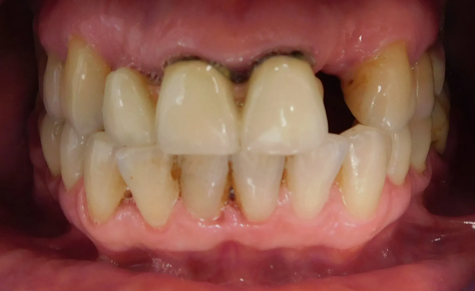 Зубы до имплантации — пример 1, клиника EK Dental, Екатеринбург