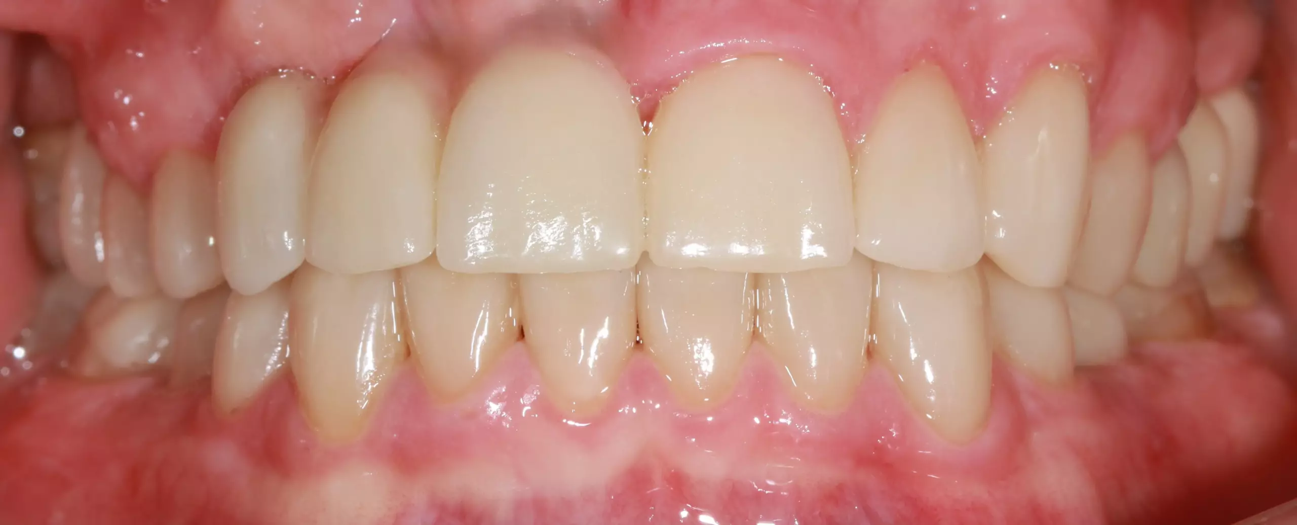 Зубы после имплантации — пример 5, клиника EK Dental, Екатеринбург