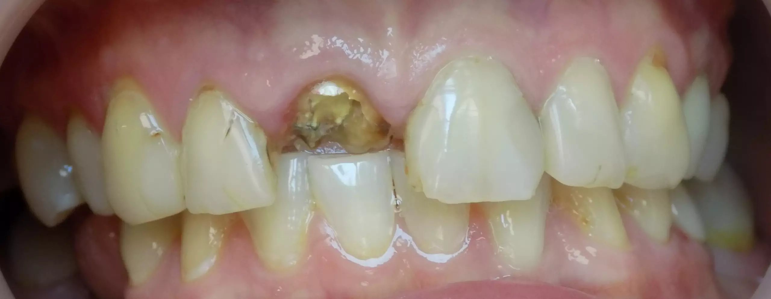 Зубы до имплантации — пример 6, клиника EK Dental, Екатеринбург