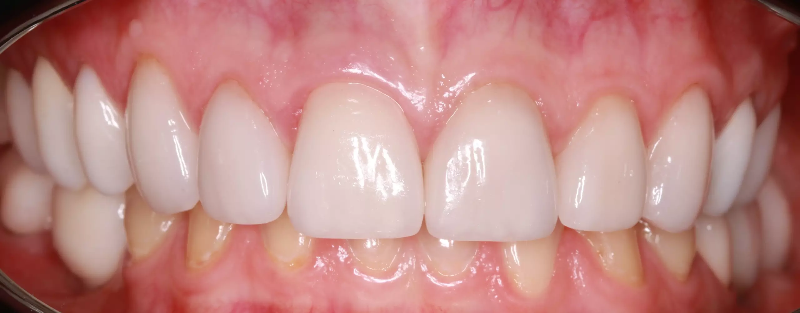 Зубы после имплантации — пример 6, клиника EK Dental, Екатеринбург