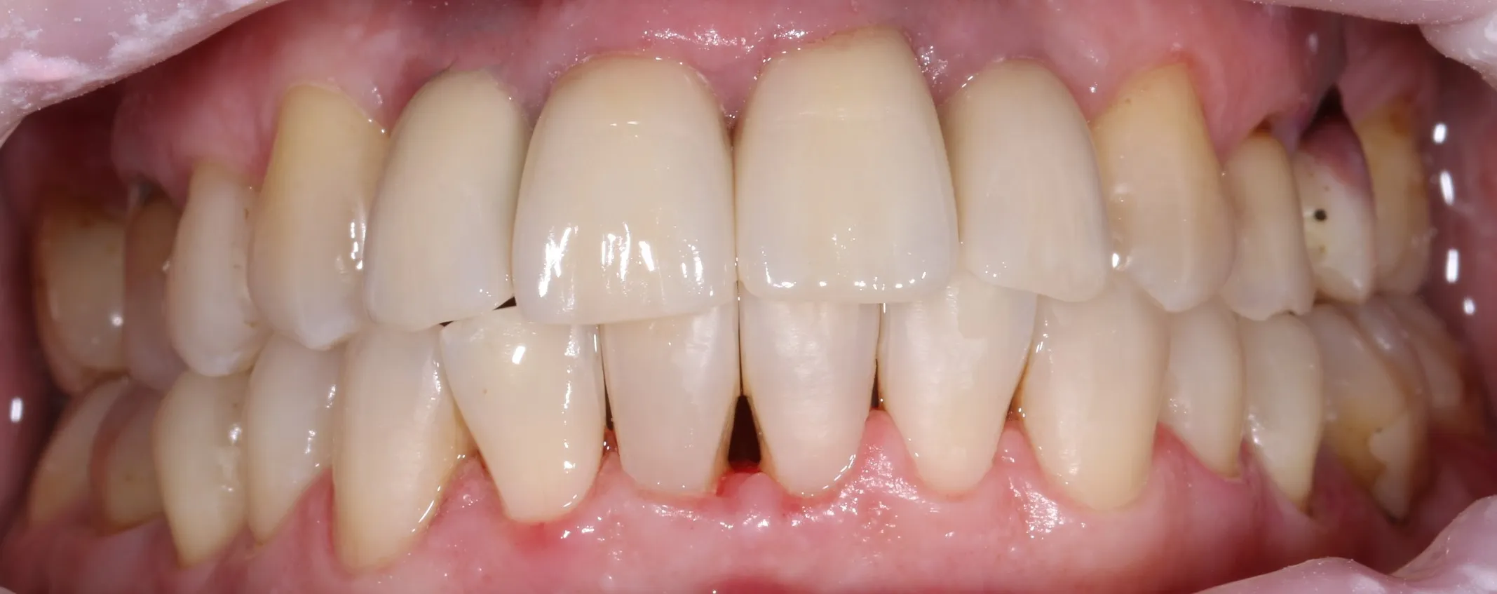 Зубы после имплантации — пример 1, клиника EK Dental, Екатеринбург