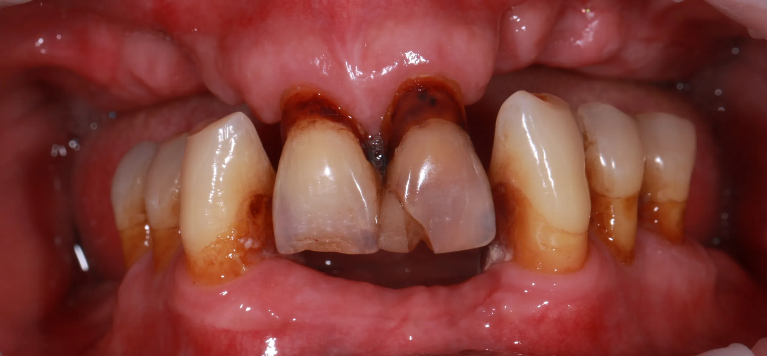 Зубы до имплантации — пример 2, клиника EK Dental, Екатеринбург