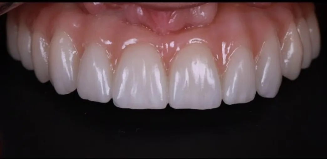 Зубы после имплантации — пример 2, клиника EK Dental, Екатеринбург