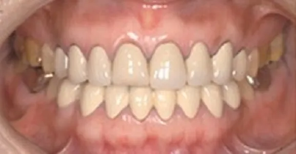 Зубы до имплантации — пример 3, клиника EK Dental, Екатеринбург