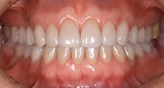 Зубы после имплантации — пример 3, клиника EK Dental, Екатеринбург