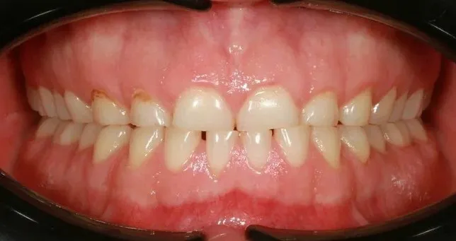 Зубы до имплантации — пример 4, клиника EK Dental, Екатеринбург