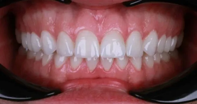 Зубы после имплантации — пример 4, клиника EK Dental, Екатеринбург
