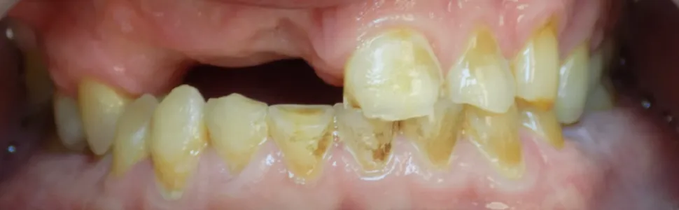 Зубы до имплантации — пример 5, клиника EK Dental, Екатеринбург